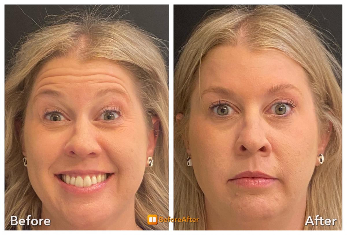 Botox before and after