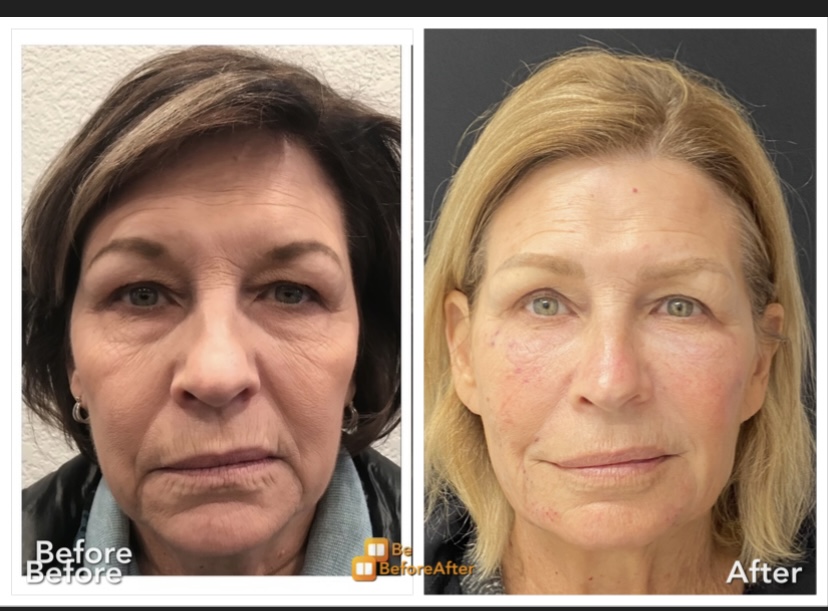 Original picture from 2018 and current picture 2023 after touchup injections