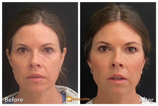 Final Before and After Filler Picture