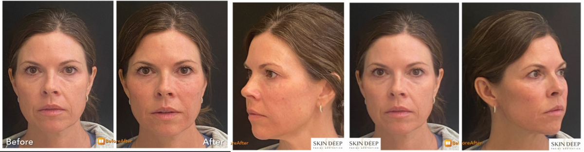 Filler Before and After