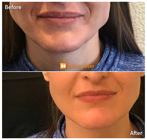 Before-After-13-01-22