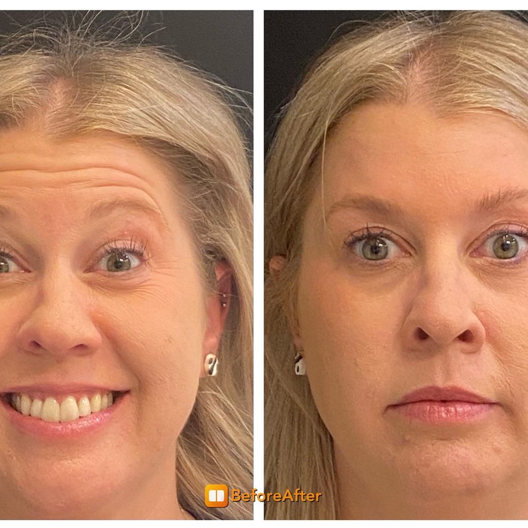 Botox before and after